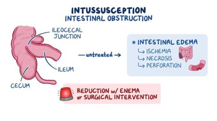 Can intussusception come back after surgery?