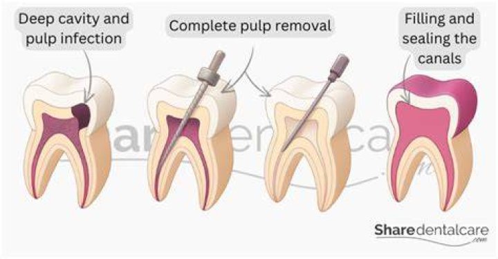When to do pulpectomy?